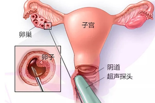 取卵的过程中痛不痛？